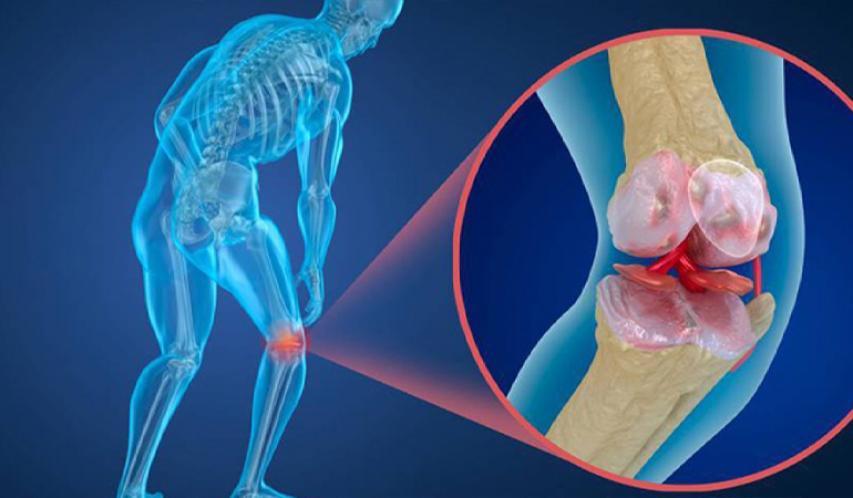 Kemik Erimesi Tedavisi